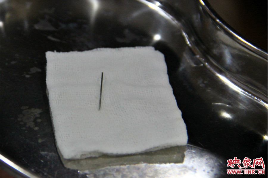 上午11點30分許，小龍腦中鋼針已經(jīng)成功取出。