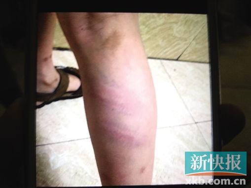 小宇腿部有明顯瘀痕。 翻拍自家屬手機