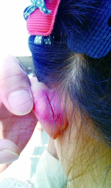 　　女童的耳朵被老師揪裂。圖片由女童家人提供