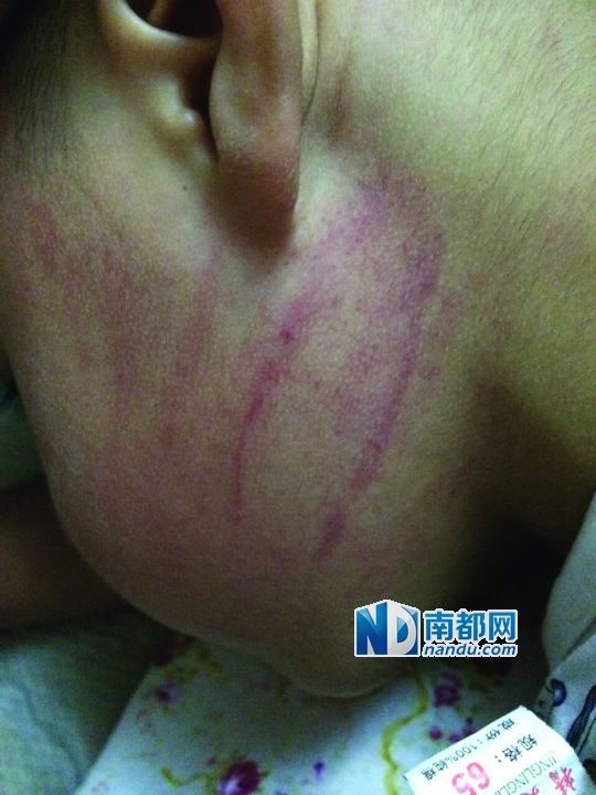 小逸臉上淤痕清晰可見(jiàn)。