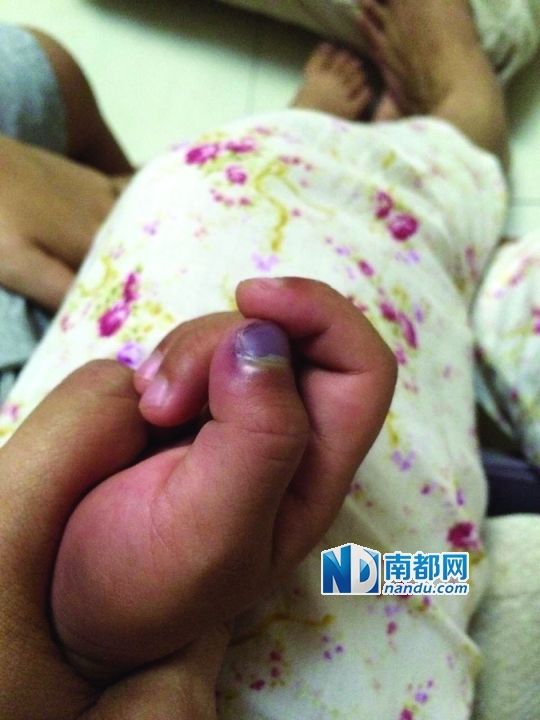 小逸手指被夾傷。