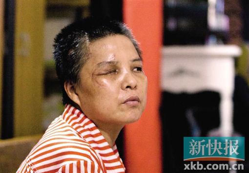 4月初,趙女士遭人搶劫并被打傷,現(xiàn)今右眼失明,頭部被縫100多針。記者 畢志毅/攝