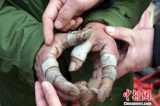 圖為由于常年拾荒，老人雙手布滿傷口。周小云 攝