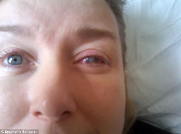 恐怖慎入！隱形眼鏡致英女子摘除眼球