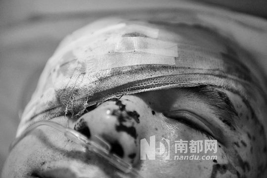 李建新頭部還有被潑硫酸的痕跡，醫(yī)生說(shuō)被砍傷的右眼已經(jīng)失明。 南都記者 田飛 攝