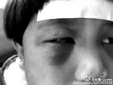 6月2日，網(wǎng)曝渭南市臨渭區(qū)一不滿5歲的女童遭奶奶毆打，眼圈青腫，引起網(wǎng)友關(guān)注，但孩子父母和爺爺均稱是摔倒導(dǎo)致。相關(guān)部門介入調(diào)查發(fā)現(xiàn)確為奶奶毆打所致，鑒于其身體原因已進(jìn)行批評(píng)教育。