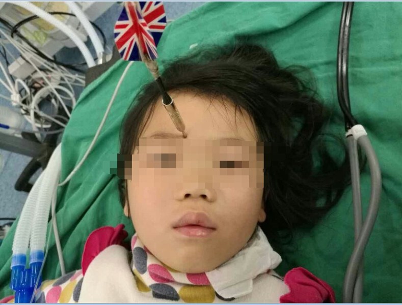 十多公分長(zhǎng)的飛鏢穩(wěn)穩(wěn)地 ” 定 ” 在了一名六歲半的女童額頭上，小青一家人凌晨從長(zhǎng)順趕到貴醫(yī)附院急診室時(shí)，看到如此慘烈的情況，接診醫(yī)生都嚇了一跳。詳細(xì)詢問下得知，原來是七歲的哥哥和六歲半的表妹在玩耍時(shí)，哥哥不慎將路邊撿來的真飛鏢扎到了妹妹的額頭上。