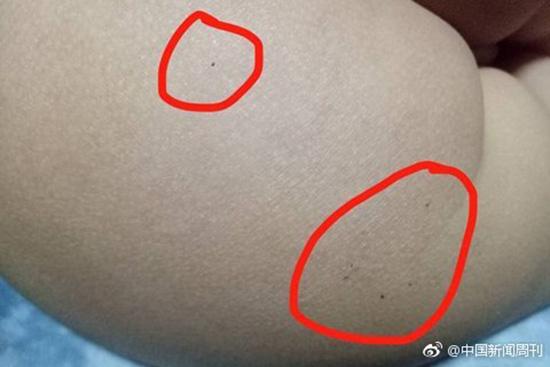 據(jù)多名紅黃藍(新天地分園)家長反映，孩子腿部、屁股、腋下出現(xiàn)針眼。