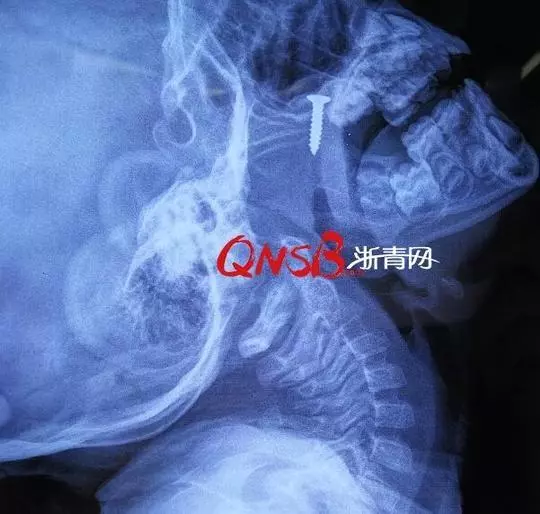 男童睡覺打鼾突然沒(méi)了呼吸 醫(yī)生從身上取出這東西