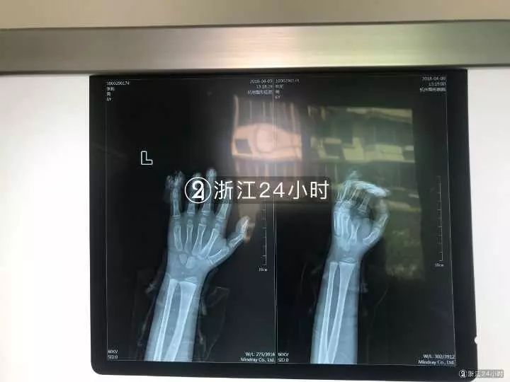 嚇哭！6歲男孩被夾斷手指 罪魁禍首竟是校服