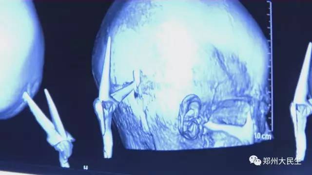 剪刀插入6歲女孩頭部 圖片讓人心驚膽戰(zhàn) 剪刀插入6歲女孩頭部 圖片讓人心驚膽戰(zhàn)