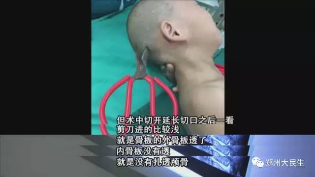 剪刀插入6歲女孩頭部 圖片讓人心驚膽戰(zhàn) 剪刀插入6歲女孩頭部 圖片讓人心驚膽戰(zhàn)