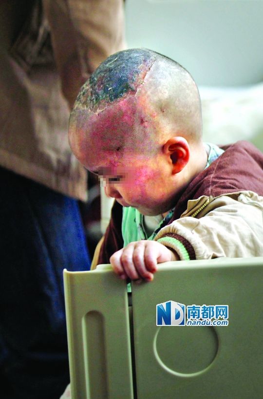 1月8日下午，小寶頭上和臉上都是傷痕。
