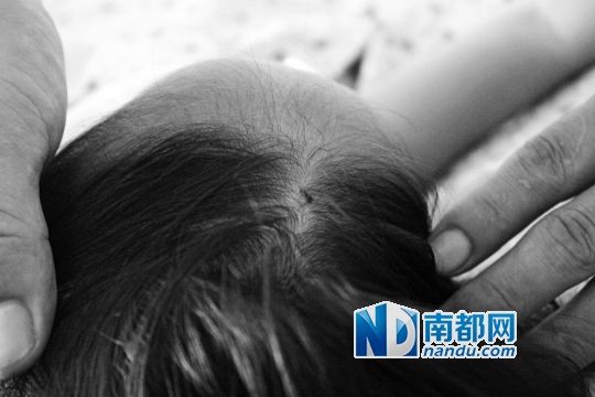 女童頭上被扎的針孔（圓圈處）。賈先生說，被扎不到三秒鐘，女兒就昏了。