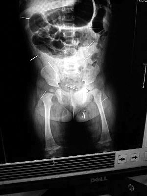 目前體內(nèi)的12根鋼針多分布在孩子的臀部，一根在腹部，其余3根在胸腔附近，其中一根很接近心臟