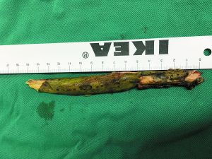 插入男子腦內(nèi)的樹枝。